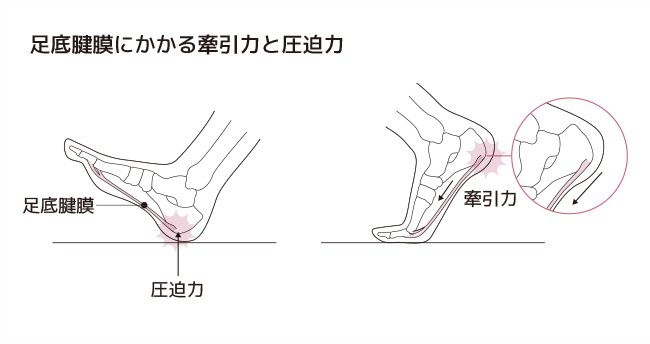 足底腱膜炎